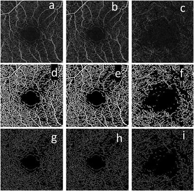 Comparison of Different Metrics for the Identification of Vascular Changes in Diabetic Retinopathy Using OCTA